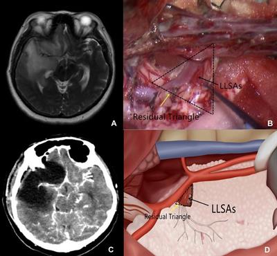 Incidence of ischemic complications and technical nuances of arteries preservation for insular gliomas resection